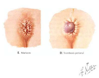 HEMORROIDES ANAL hemorroides anal: